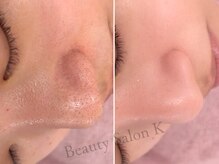 ケイ(K)の雰囲気（毛穴の黒ずみや毛穴開きも改善◎すっぴんでも自信を持ちたい肌へ）