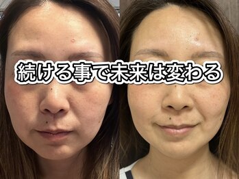 サクラ 伊勢原店(SAKURA)/フェイシャルエステ以上の効果