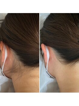 インベスト(INVEST)/うなじ脱毛