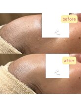 パンジー 上野フェイシャルエステ専門店(pansy)/*フェイシャル/ニキビケア*