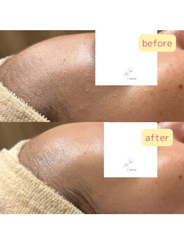 パンジー 上野フェイシャルエステ専門店(pansy)/*フェイシャル/ニキビケア*