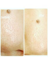 ラナ(Lana)/毛穴ケア☆