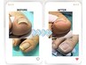【新メニュー】巻き爪補正（爪の片側1ヶ所￥8,800＋補助上げ￥2,200）