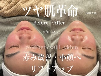 エステティックス ナインワンワン 横浜(Esthetics911) /ツヤ肌革命！赤み改善・小顔へ