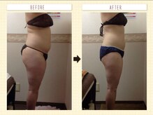 エステティックサロン ピュール ボーテ 東金店/ハイパーナイフ