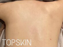 トップスキン 名駅(TOPSKIN)/ダウンタイムありハーブ5回施術