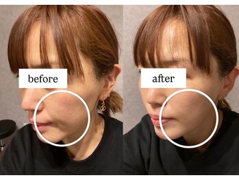 ビー ブルーム(B BLOOM)/【リフトアップ小顔】