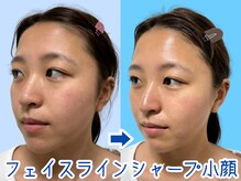 ナチュラルパーフェクトフェイス 新宿/ほほ、顎スッキリ/新宿小顔矯正