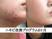 アエオボンヌール(A.E.O BONHEUR)の雰囲気（体内環境の整え、お肌の修復力を高めて繰り返すニキビ卒業へ）