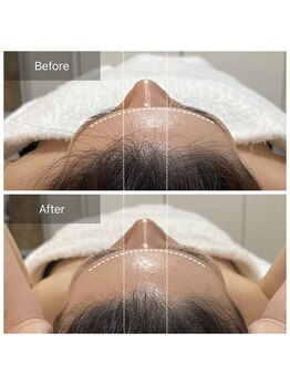 ロエン(Roen)/3D小顔★クラニオメソッド