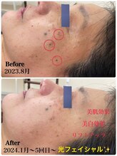 ソレイユ/光フェイシャル