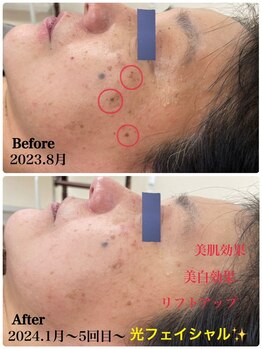 ソレイユ/光フェイシャル