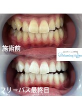 ホワイトニングサロン 熊本店/お手軽ホワイトニング