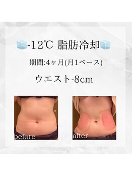 メディカルエステ 東銀座店/-12℃脂肪冷却 before/after