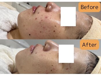 パンジー 上野フェイシャルエステ専門店(pansy)/*フェイシャル/ニキビケア*