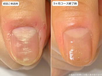 カピリナ(Ka Pilina)/自爪育成・深爪・川崎