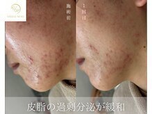 ベルフィーヌ 目黒店(BELFINE)/剥けるハーブピーリング