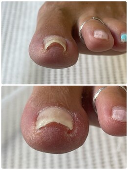 巻き爪じゅん 千葉駅前店/当院の施術で再発予防