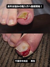 巻き爪じゅん 千葉駅前店/陥入爪による痛みを改善へ