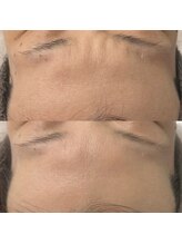 ヴェルシック(Belchic)/おでこと眉間もここまで変わる