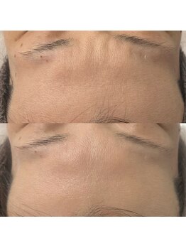 ヴェルシック(Belchic)/おでこと眉間もここまで変わる