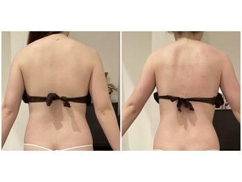 エンフィール(&.Feel)/短期モニター様4回効果写真