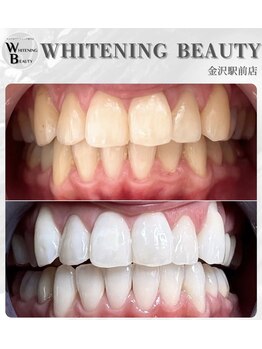 ホワイトニングビューティー 金沢駅前店(WHITENING BEAUTY)/初回でも効果を実感できる!
