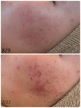 ユフラ(Juhla)/毛穴洗浄+韓国ハーブピーリング