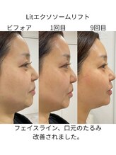 フラワー(FLOWER)/Lit5回目の肌変化