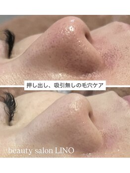 リノ(LINO)/押し出し、吸引なしの毛穴ケア