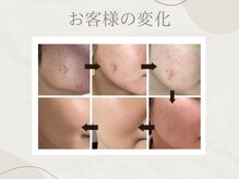 アイル 金山店(iru)の雰囲気（剥離ありハードハーブピーリングを6回目のお客様）