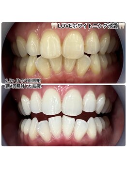 ラブホワイトニング 渋谷店(LOVEホワイトニング)/初回12回照射ホワイトニング