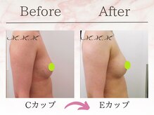 エムエムエム 表参道Luxeサロン(M.M.M)/【バストアップ例】　C→Eカップ