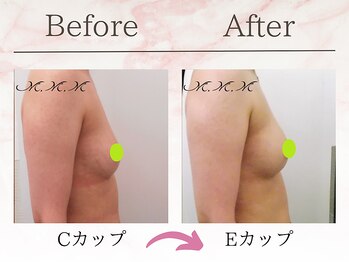 エムエムエム 表参道Luxeサロン(M.M.M)/【バストアップ例】　C→Eカップ