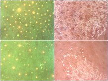 ベベ 高崎本店(Be'be')/毛穴カウンセリング(カメラ）