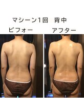 エクレボーテ(ECOULERBEAUTE)/マシーン施術回数1回　背中