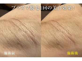 アネル 美里店(anel)/プラズマ脱毛