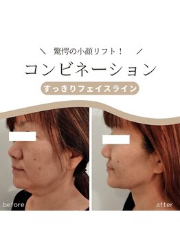 クリニカルエステ リフィーナ 辻堂店/コンビネーション