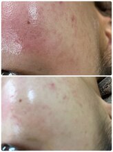 ルーメ(lume)/20代女性