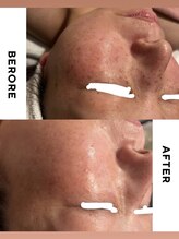 インフィニティ(INFINITY)/シミケア【お顔】