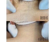 サロン ルーシュ(salon ruche)/脱毛(うなじ)