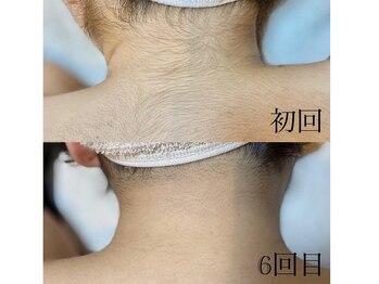 サロン ルーシュ(salon ruche)/脱毛(うなじ)