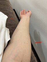 ことぶき整骨院/鍼灸施術　花粉や頭痛にも