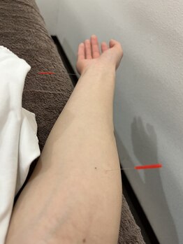 ことぶき整骨院/鍼灸施術 花粉や頭痛にも