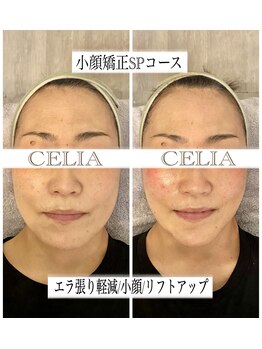 セリア(CELIA)/小顔矯正/小顔//面長/エラ張り