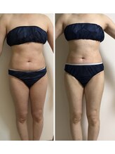 ミューズスタイル(muse style)/インキュア効果3.5回