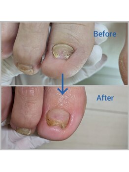かとり台整骨院 つくば/肥厚爪・厚硬爪のケア