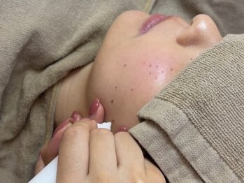 シミケア専門サロン Lotus. 千早香椎店【シミ/シワ/毛穴/小顔】の写真/ホウレイ線・たるみ改善！透明感・ぷるんと弾力のあるツヤ肌に[シミしわケアフェイシャル￥8500]