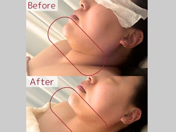 シャイニー(SHINY)の写真/痩身性美容液レッドショットで韓国美肌へ導く！理想の小顔エステ体験♪