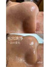 ベルティ(Bellti)/毛穴洗浄